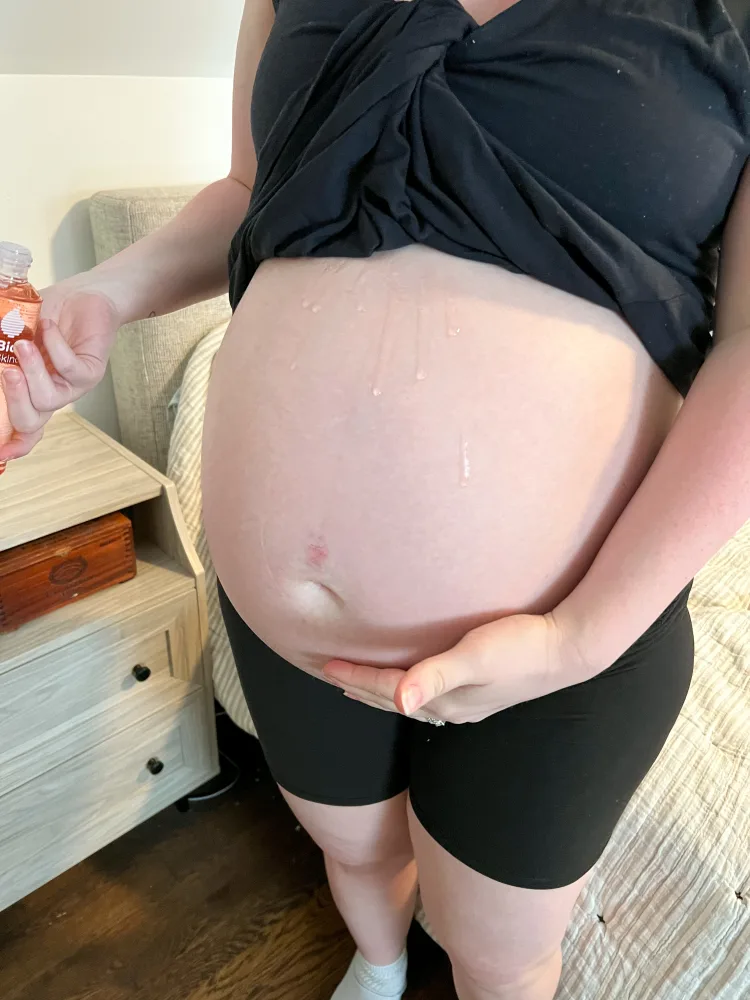 Mums & Chums - What with these stretch marks? 1. Use specially formulated  cream or oils 2. Start as soon as you find you are pregnant 3. Prevention  measures are better than