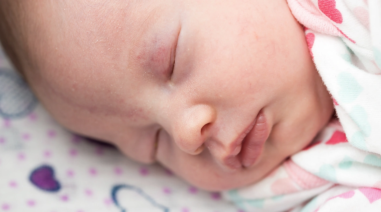 Stork Bite Birthmarks: Appearance, Causes And More