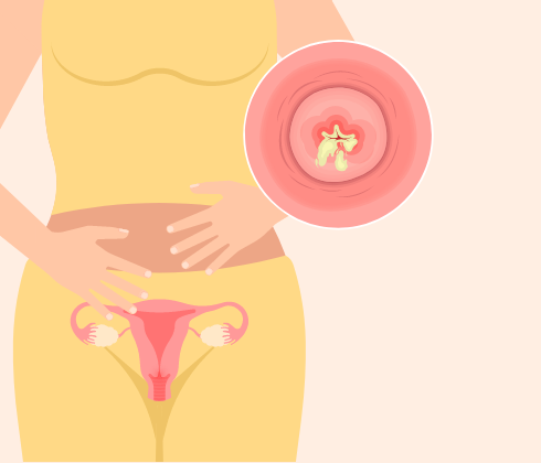 Queensland Health - Vaginal discharge: the lowdown on your downtown. 👇 Vaginal  discharge is a clear, whitish fluid that comes from tiny glands in the  vagina and cervix. This fluid leaks from