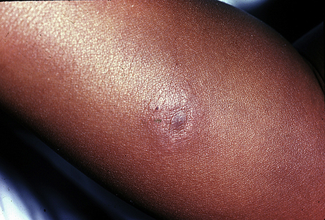 Subtle Erythema Migrans (EM) rash, shown on person with darker skin 