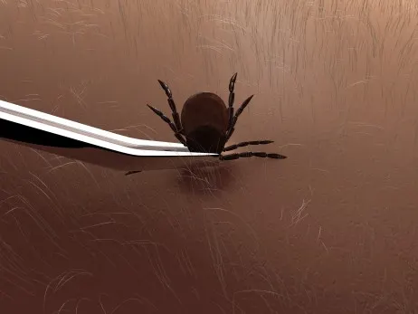 Illustration of a tick attached to someone's skin, being held upright with a pair of tweezers