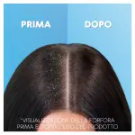 Visualizzazione della forfora prima e dopo head & shoulders