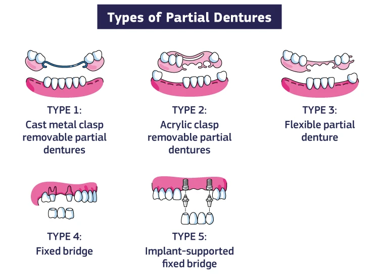 An infographic showing the types of partial dentures: Type 1: Cast metal clasp removable partial dentures Type 2: Acrylic clasp removable partial dentures Type 3: Flexible partial denture Type 4: Fixed bridge Type 5: Implant-supported fixed bridge