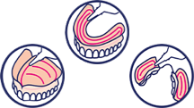 Apply adhesive in thin continuous lines as shown or less. You might need a few tries to find out the ideal amount for your individual denture.
