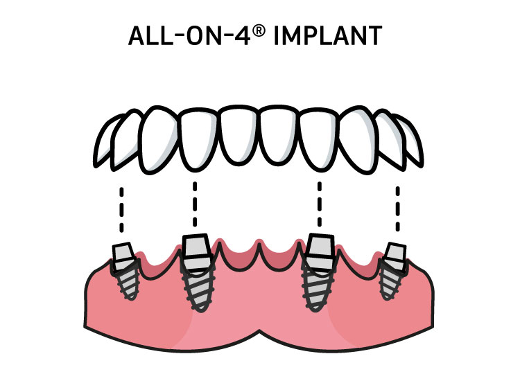 Infographic showing an all-on-4 implant and its components 
