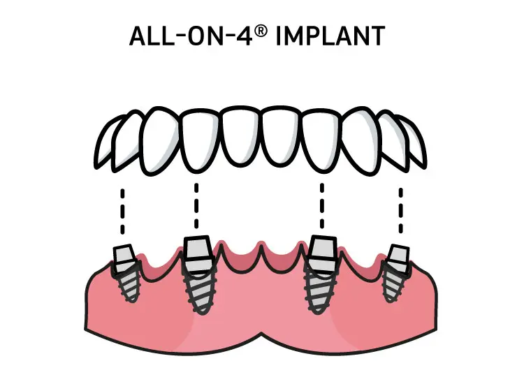 tooth implant types