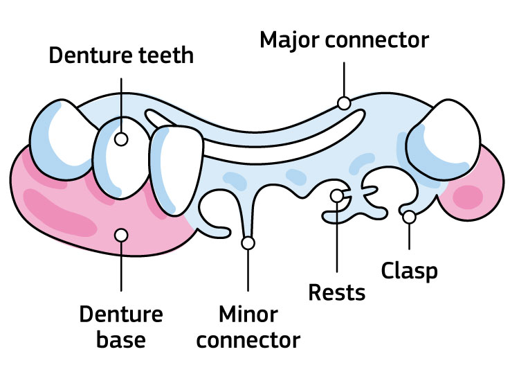 An infographic showing the Parts of partial removable dentures: denture teeth, major connector, denture base, minor connector, rests, clasp.