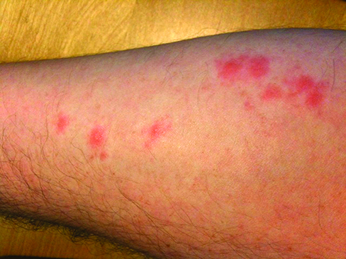 insect bites red marks