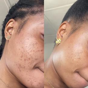 How To get Rid of Dark Spots On Your Face According to Experts