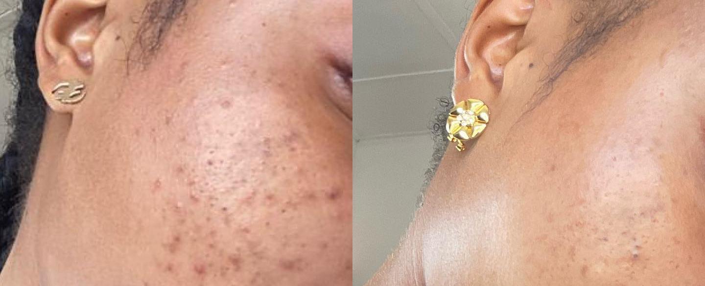 How To get Rid of Dark Spots On Your Face According to Experts