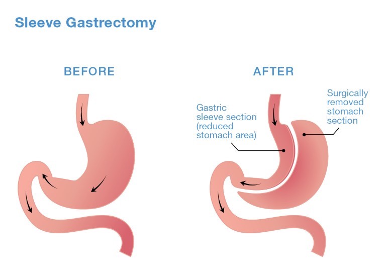 Sleeve-Gastrectomy