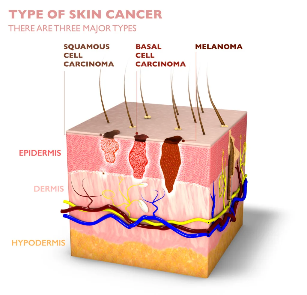 Graph of Skin