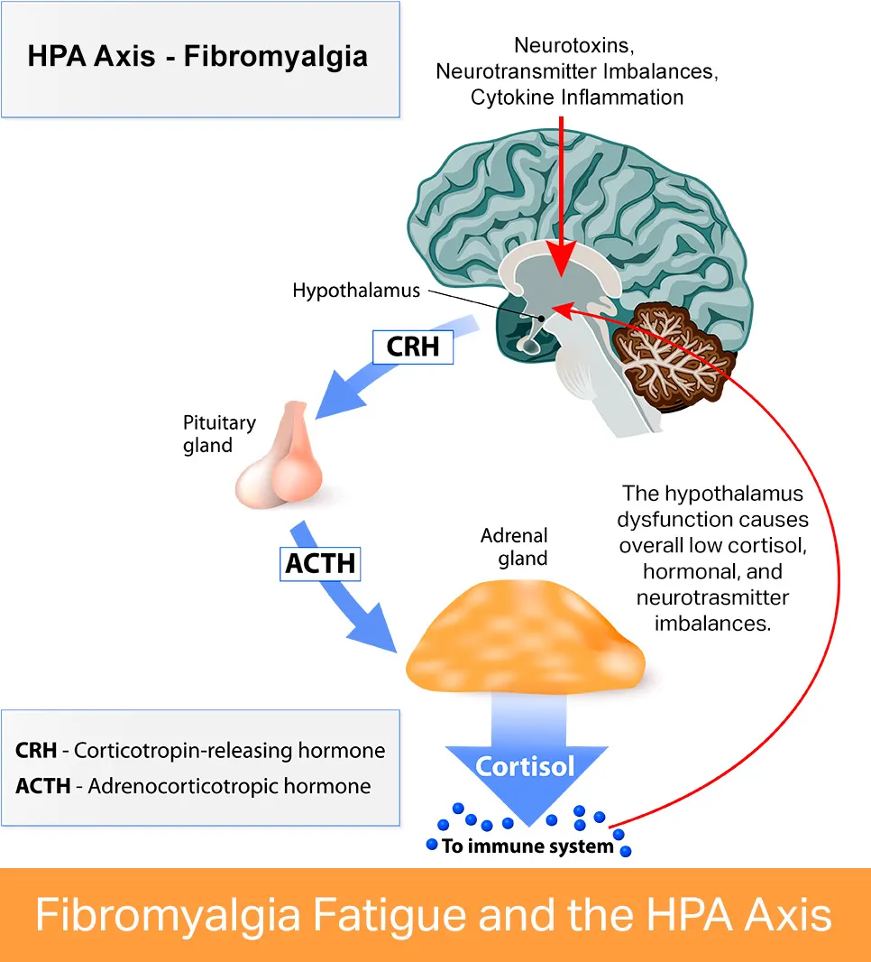 Is Your Fibromyalgia Caused by an Infection?