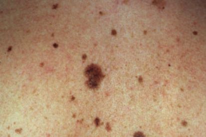 Dysplastic Nevi | Cumberland Skin Surgery & Dermatology | Cumberland Skin | Dermatology & Skincare