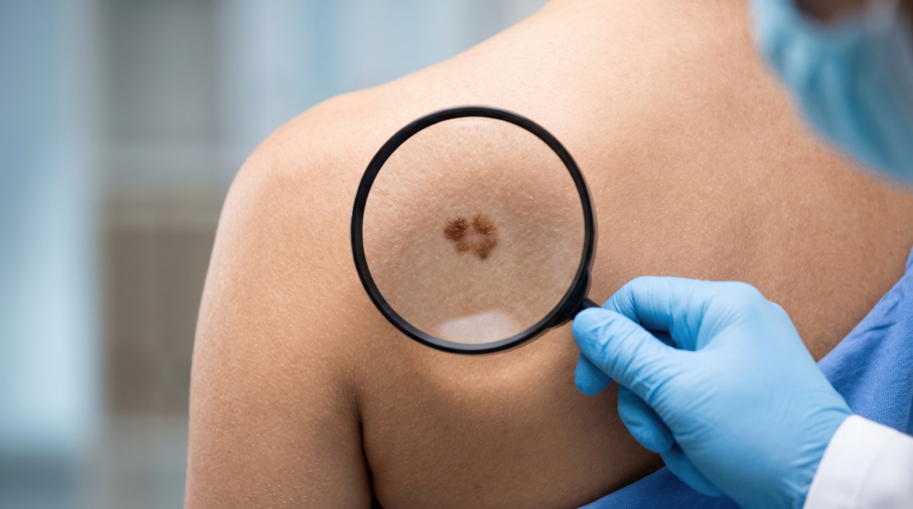 What Happens During a Total Body Skin Exam 3