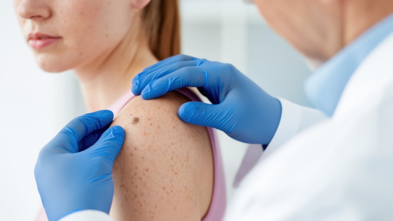 What Happens During a Total Body Skin Exam 2