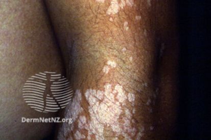 Tinea Versicolor | Rencic Dermatology | Rencic Dermatology | Board-Certified Dermatologists