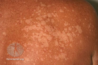 Tinea Versicolor | Bikowski Skin Care Center | Bikowski Skin Care Center | Expert Dermatology and Cosmetic Solutions