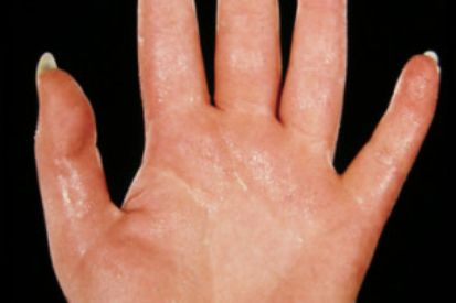 glutathione and hand sweating Hyperhidrosis vs. Normal | Tru-Skin Dermatology | Tru-Skin sizes Glutamate, Glutamine, Glutathione, and Size:30 servings