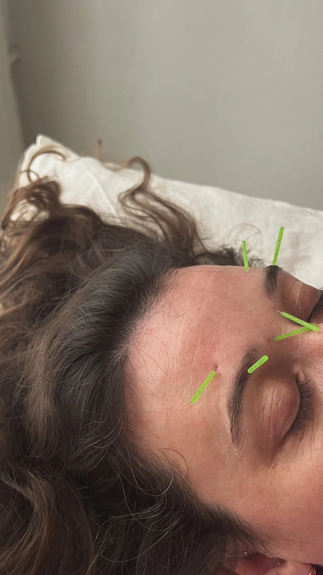 Needles in forehead