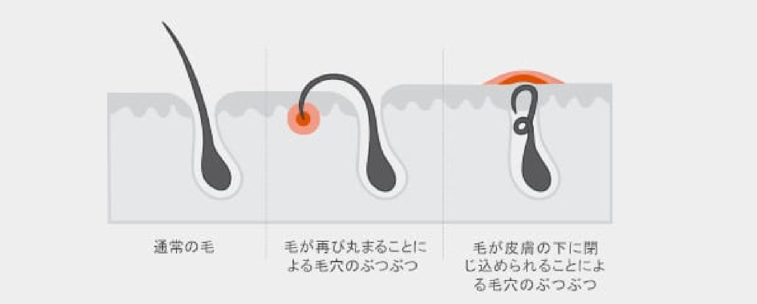 毛穴のぶつぶつと埋没毛の対処法 ジレット ジャパン