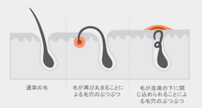 毛穴のぶつぶつと埋没毛の対処法 ジレット ジャパン