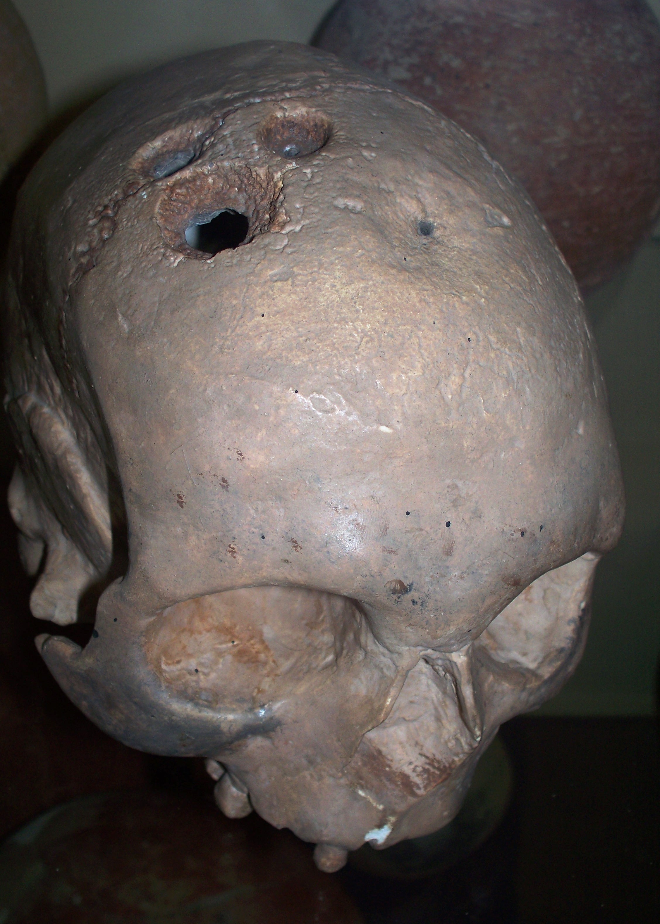 Srovnávací lebka s trepanací z doby bronzové ukazuje typ kostních stop, podle nichž badatelé odlišují operaci od úrazu. Kredit: High Contrast, Wikimedia Commons, CC BY 3.0 DE