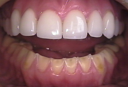 A modern clinical example of dental tissue loss helps orient readers to the visible defects scientists compare; it is not a specimen from the primate study. Photo: David Shankbone, Wikimedia Commons, CC BY 3.0