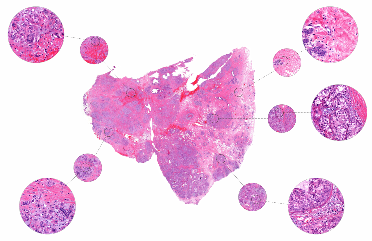 First comprehensive look at breast cancer in Native American women reveals key genetic differences