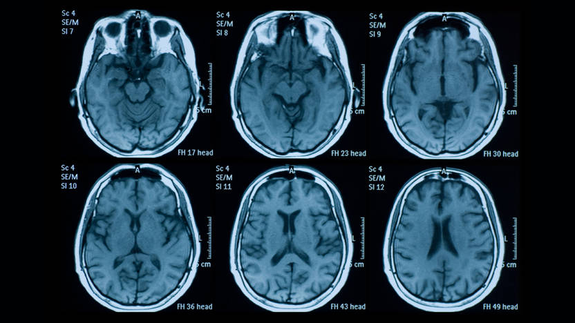 MRI improves differential diagnosis of MSA, PSP, and PD | Neurodiem