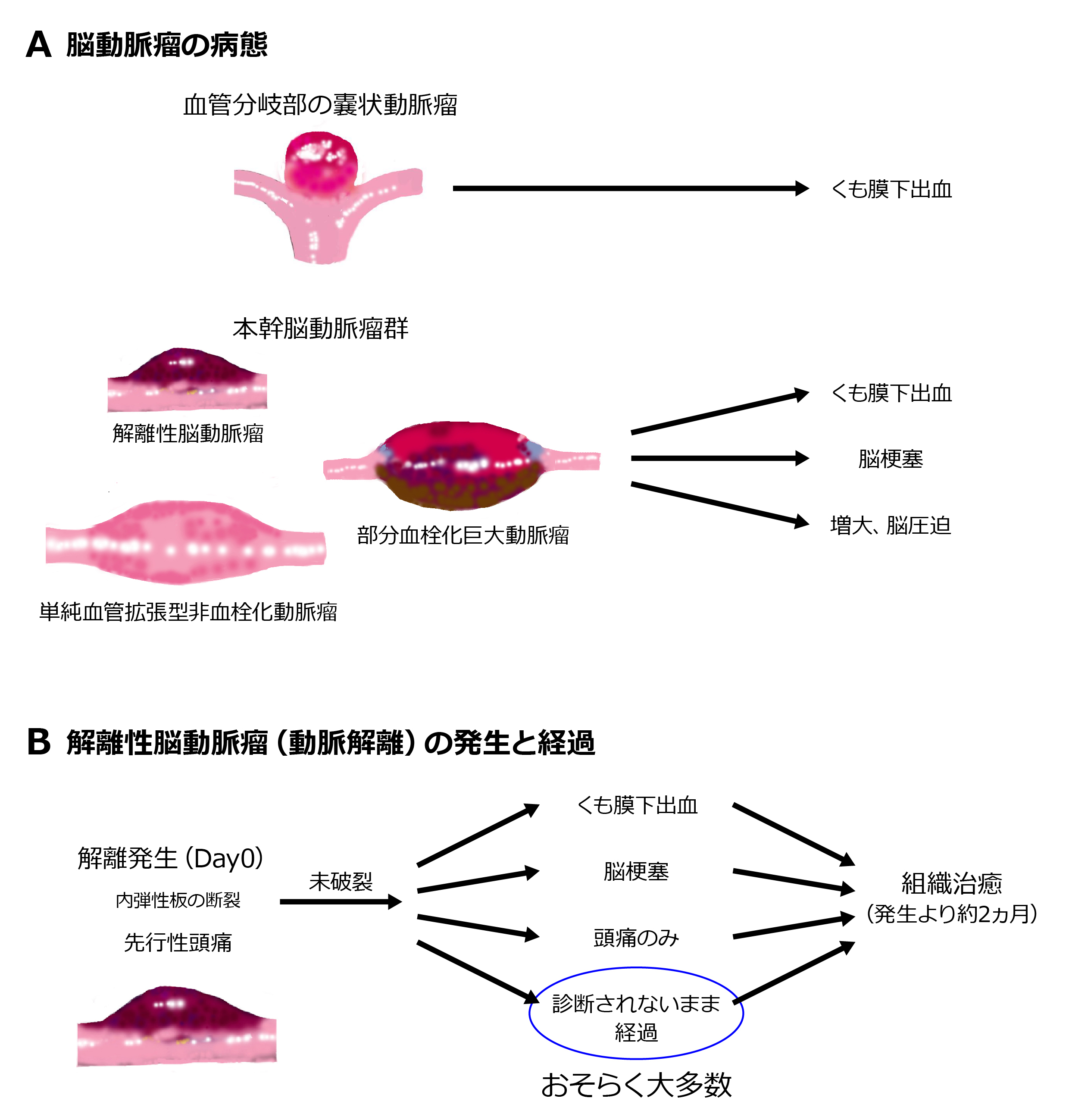 解離性脳動脈瘤と本幹脳動脈瘤群 ―現状と今後の課題― | Neurodiem