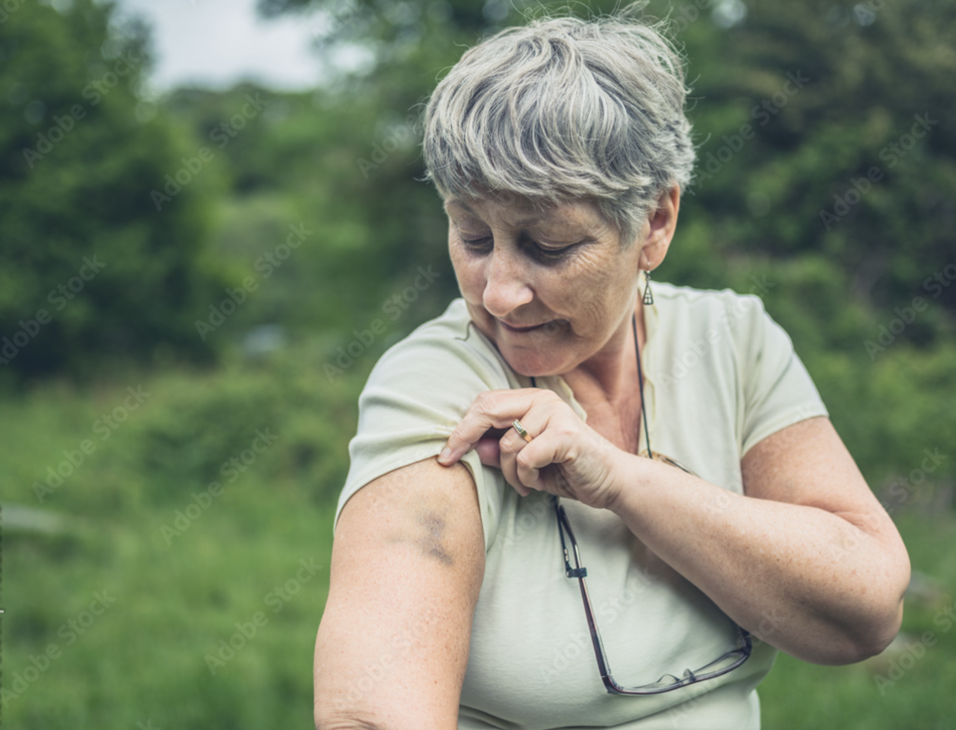 Why Do I Bruise So Easily The Vitamin Deficiency Connection