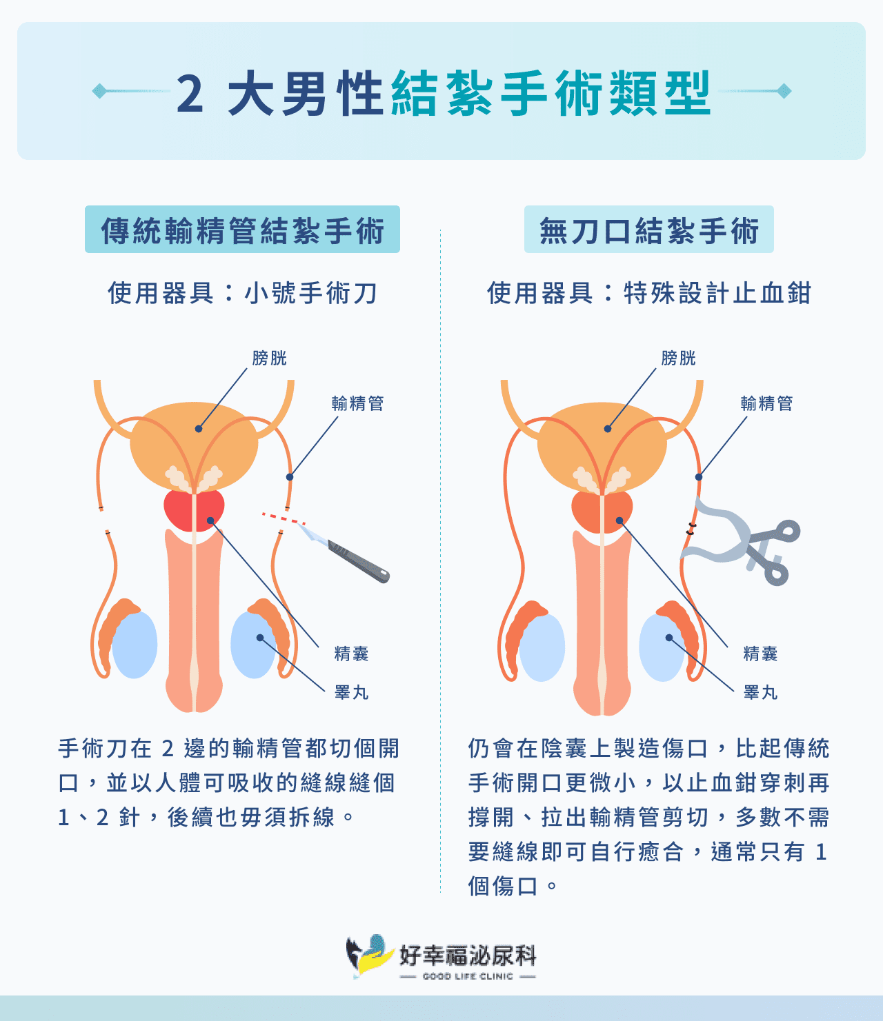 2 大男性結紮手術類型