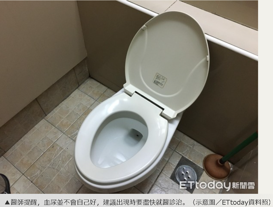 2疾病恐冒「無痛血尿」 泌尿醫:不會自己好