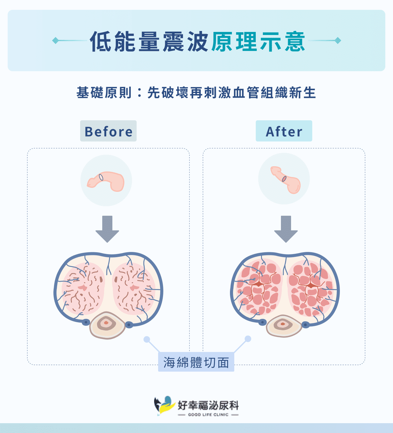 低能量震波原理示意！