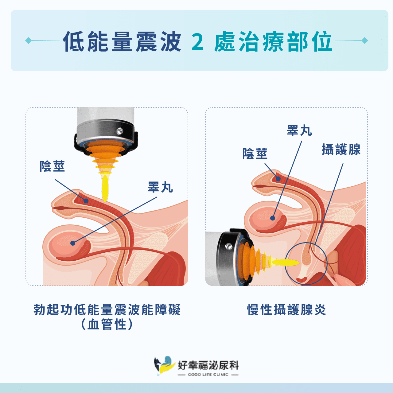 低能量震波 2 處治療部位