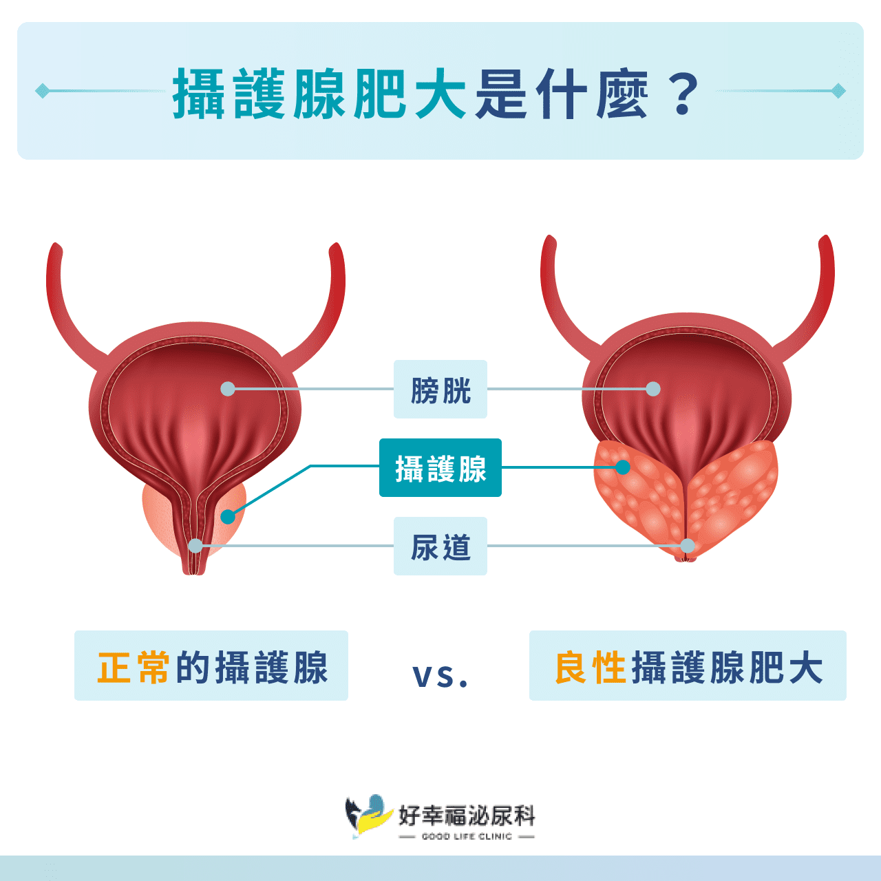 攝護腺肥大是什麼？