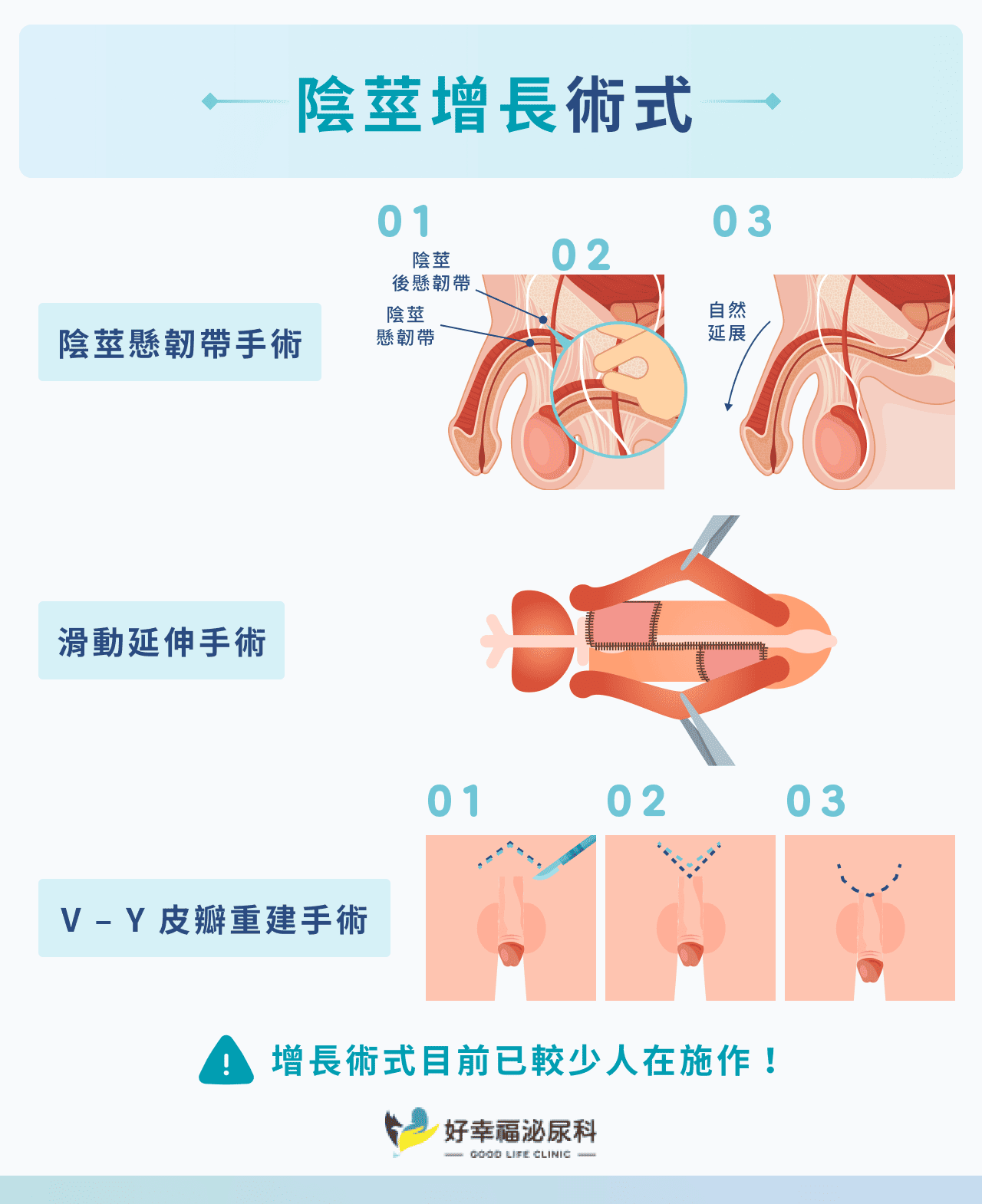 陰莖增長術式