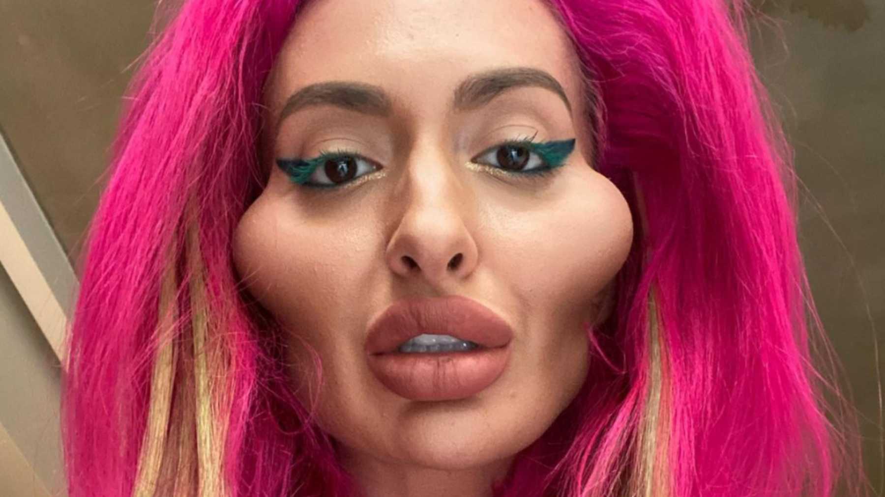 All About Ig Model Who Is Addicted To Cheek Fillers And Has Biggest Cheeks In The World