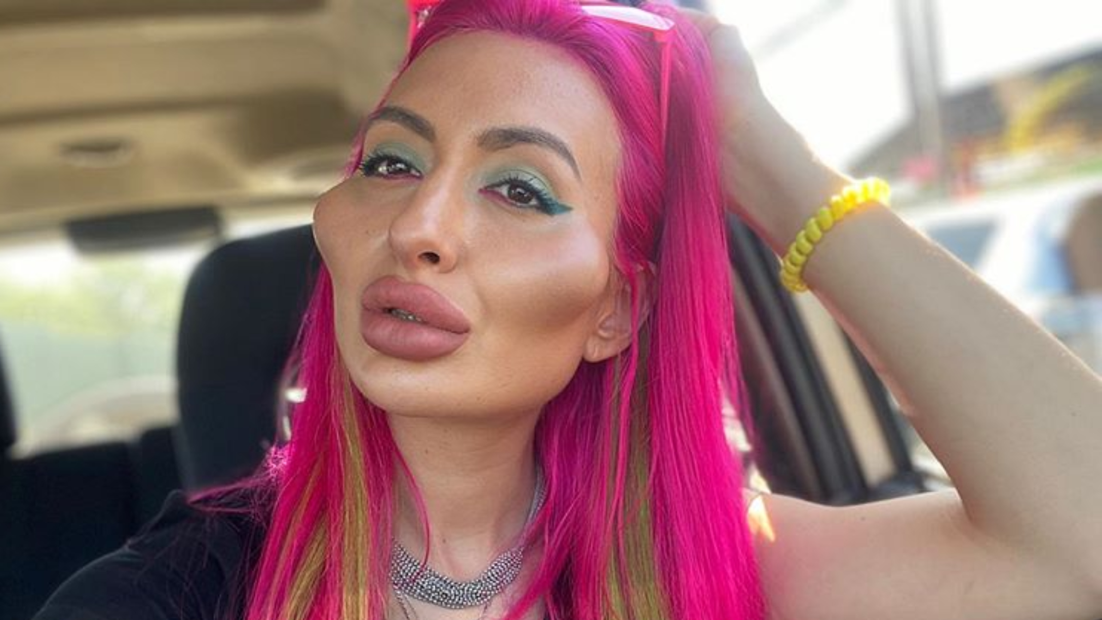 Esta mujer tiene los "pómulos más grandes del mundo" gracias a las