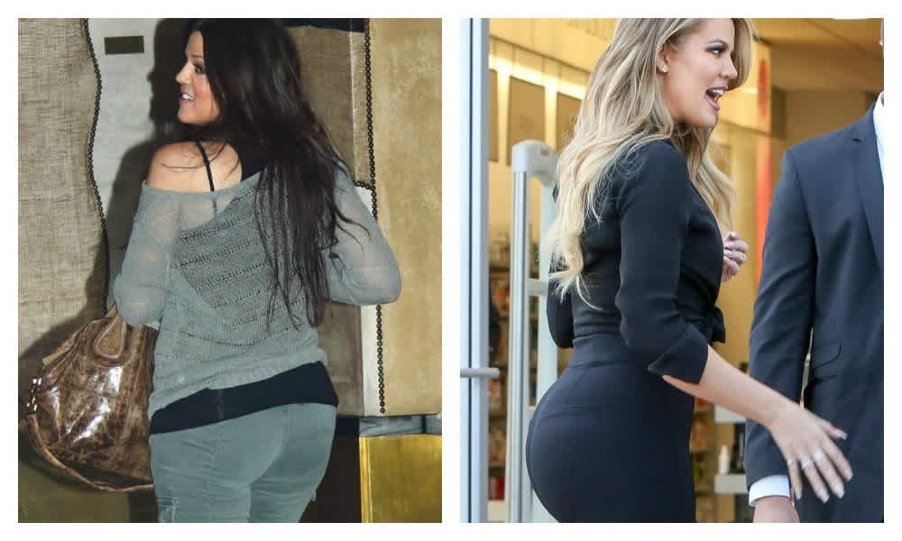 Celebrity Butt Implants: Before-and-After Pics of Stars' Booties
