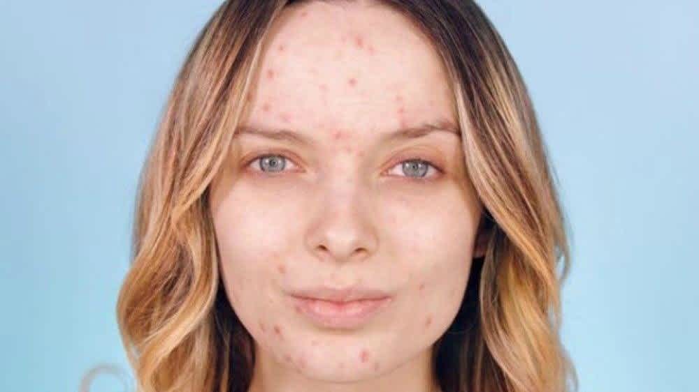 girl with no makeup and pimples