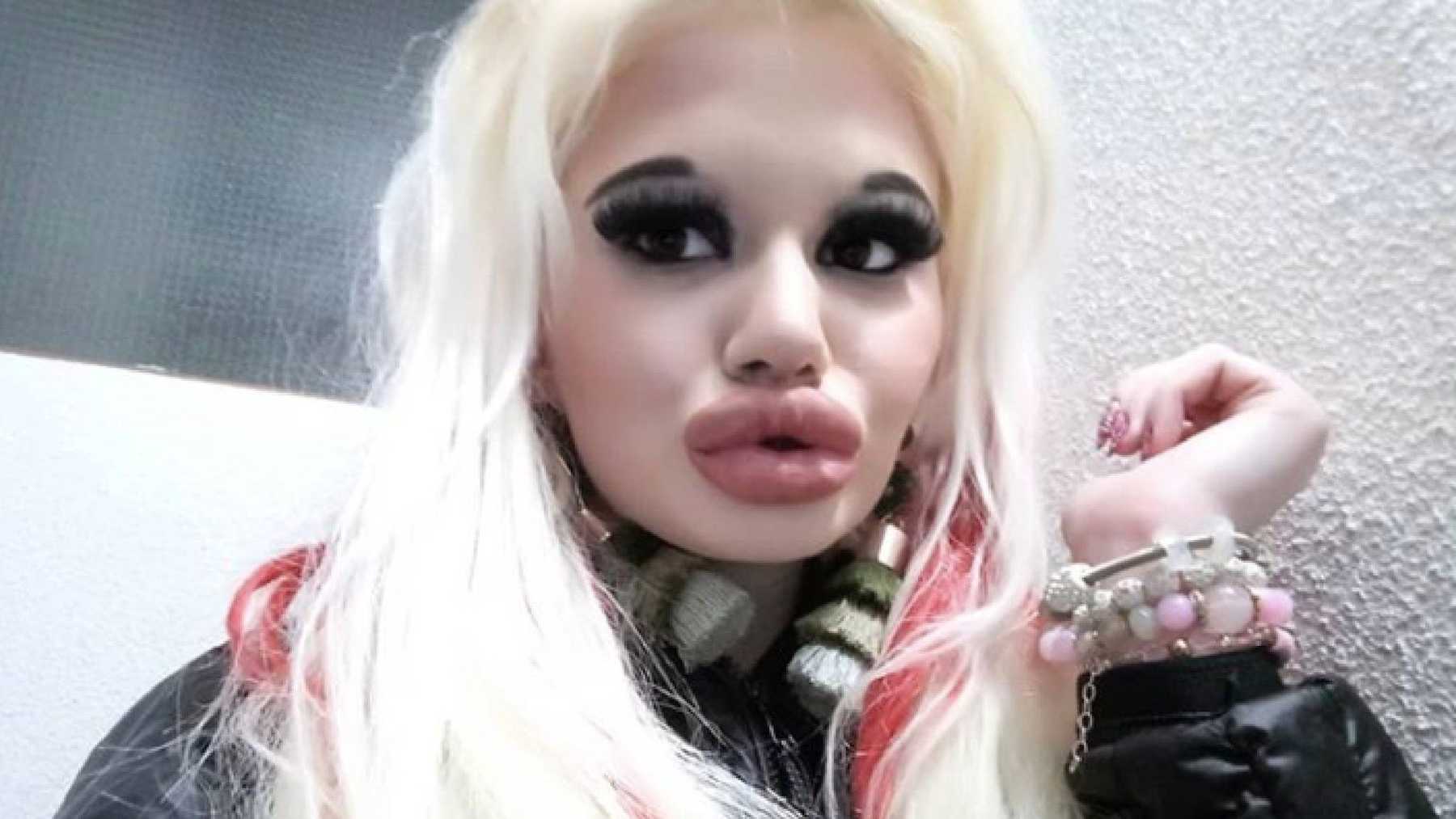 Real-life Barbie who had over 15 surgeries, 20 lip fillers