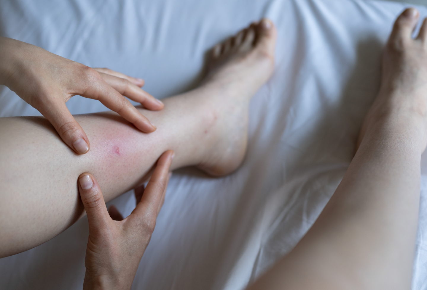 Human leg with flea bite