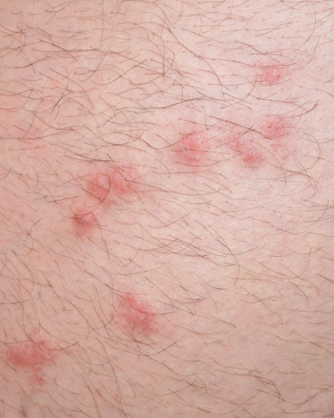 Cluster of red and raised flea bite marks on human skin.