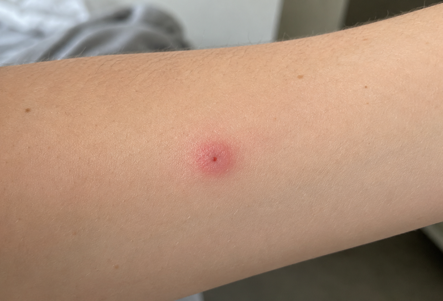 Flea bite on human arm picture