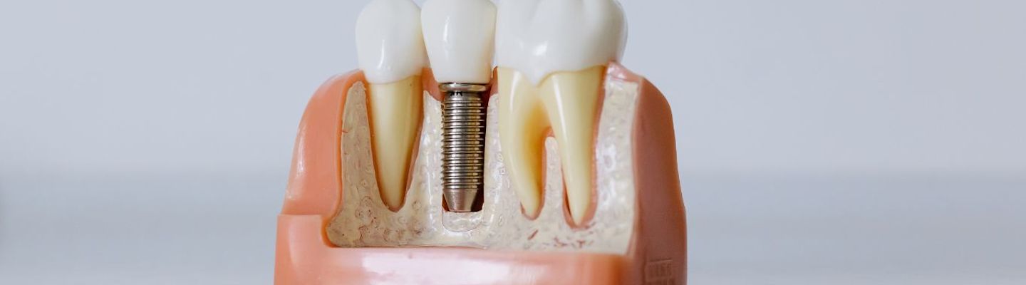 Model of a teeth fitted with screw
