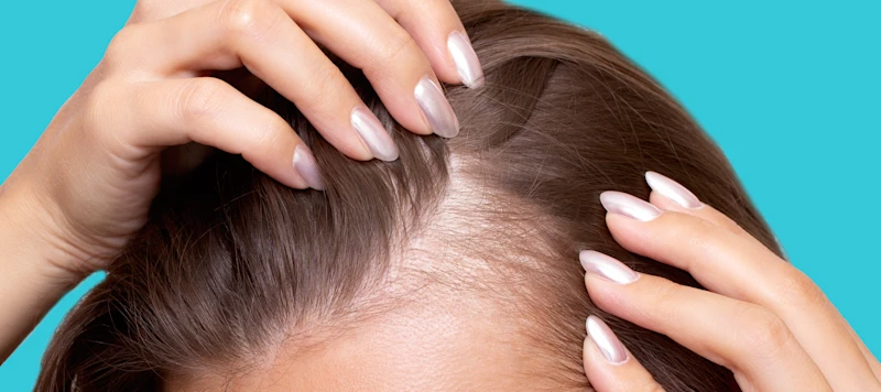 A woman with fair skin and light brown thinning hair holds it apart at the roots in front of a light blue background.