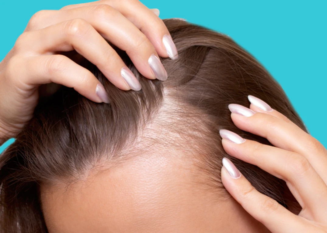 A woman with fair skin and light brown thinning hair holds it apart at the roots in front of a light blue background.