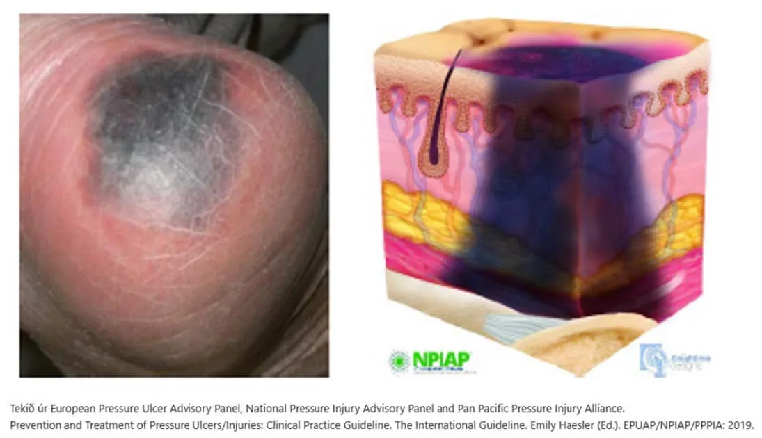 Pressure sore prevention - Consequences, stages and classification ...